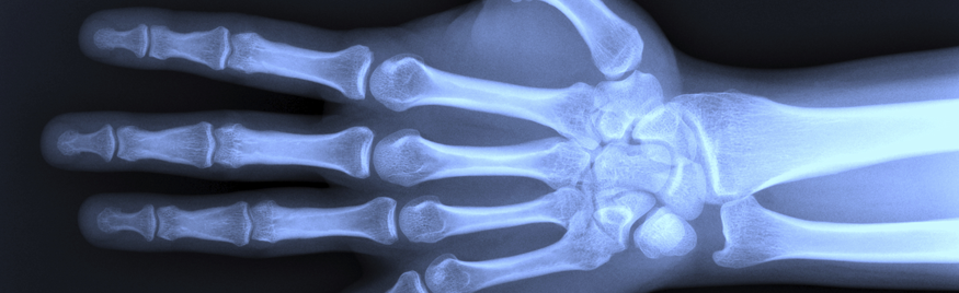 X-ray of Hand